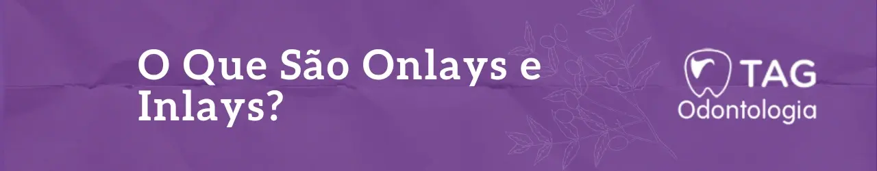 O Que São Onlays e Inlays