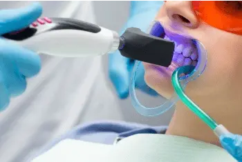 clareamento-dental
