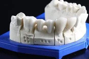 coroa-e-ponte-dentaria