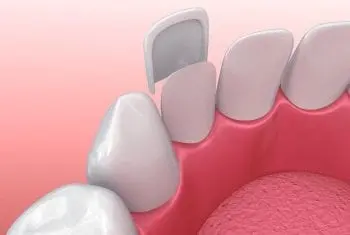 facetas-dentarias-e-lumineers