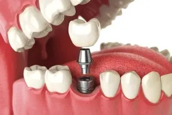 implantes-dentarios