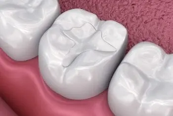 obturacoes-dentarias