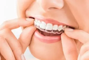sistemas-clear-aligner-invisalign